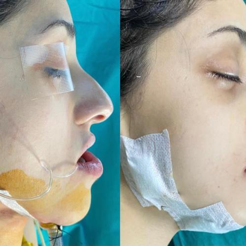 عملية الفك صور قبل وبعد